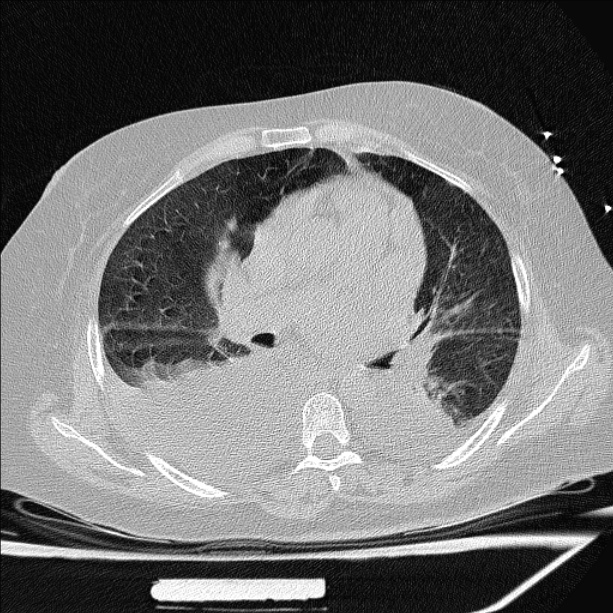 Cardiogenic pulmonary edema (Radiopaedia 29213-29609 Axial lung window 44).jpg