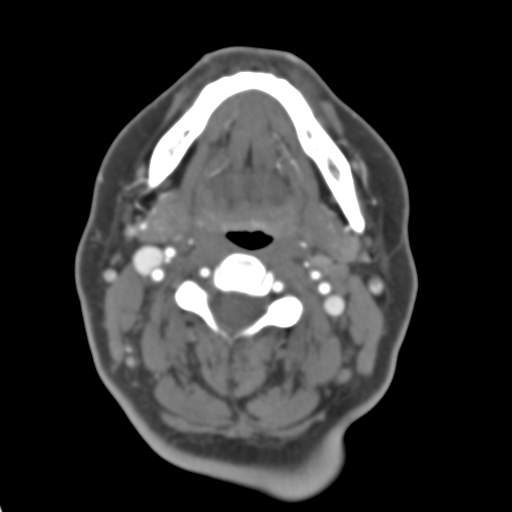 Carotico ophthalmic aneurysm (Radiopaedia 42916-46148 A 64).png