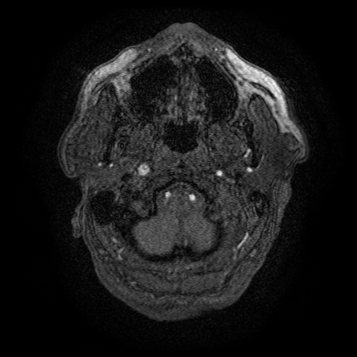 Carotid arterial dissection with acute cerebral infarction (Radiopaedia 26636-26784 MRA 168).jpg