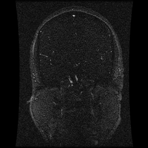 Carotid arterial dissection with acute cerebral infarction (Radiopaedia 26636-26784 MRV 100).jpg