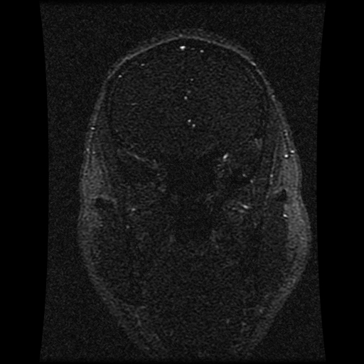 Carotid arterial dissection with acute cerebral infarction (Radiopaedia 26636-26784 MRV 120).jpg