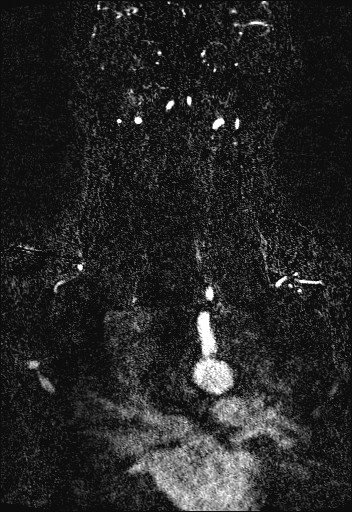 Carotid artery dissection (Radiopaedia 28441-28689 Coronal MRA 65).jpg