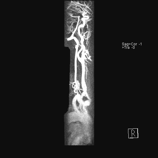 File:Carotid artery dissection (Radiopaedia 28441-28689 MIP Carotids MRA 14).jpg