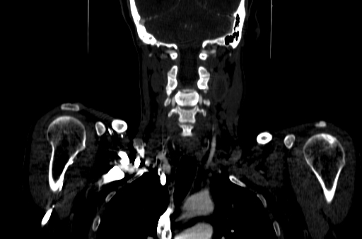 File:Carotid bulb pseudoaneurysm (Radiopaedia 57670-64616 D 49).jpg