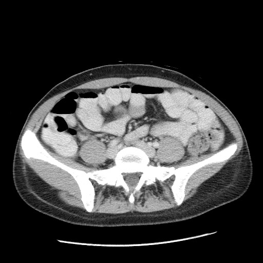 Castleman disease with fibrous pseudotumor in the abdomen (Radiopaedia 77296-89373 A 84).jpg