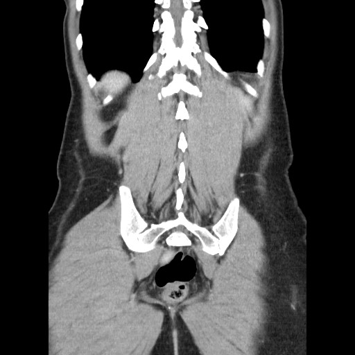 Castleman disease with fibrous pseudotumor in the abdomen (Radiopaedia 77296-89373 B 77).jpg