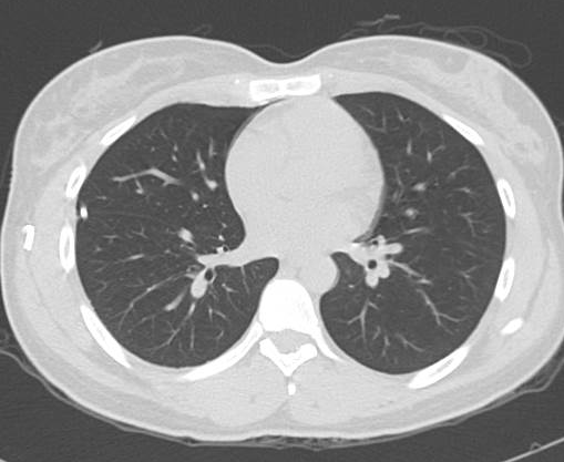 File:Catamenial pneumothorax (Radiopaedia 54382-60600 Axial 24).png