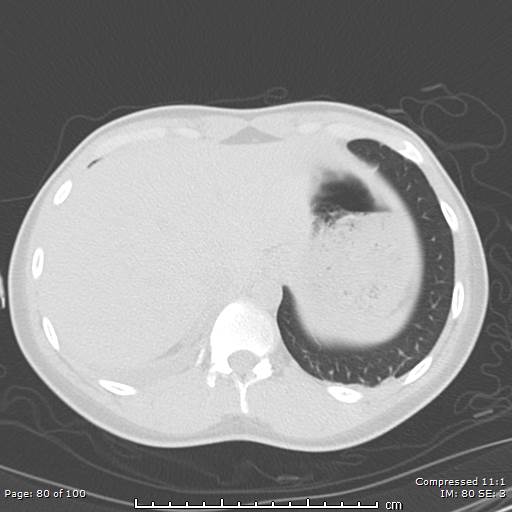 File:Catamenial pneumothorax (Radiopaedia 54382-60600 Axial non-contrast 80).jpg