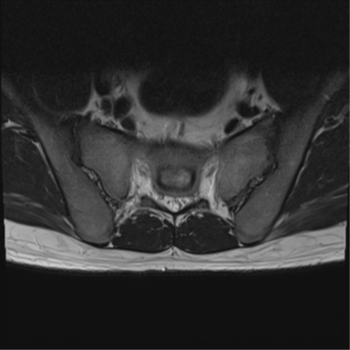 File:Cauda equina syndrome (Radiopaedia 53615-59672 Axial T2 1).png