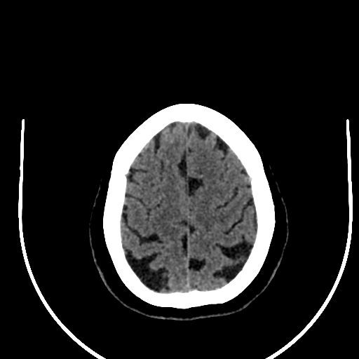 Cavernous hemangioma of the cerebellar falx (Radiopaedia 73025-83723 Axial non-contrast 114).jpg