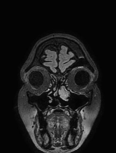 Cavernous hemangioma of the cerebellar falx (Radiopaedia 73025-83724 Coronal FLAIR 23).jpg