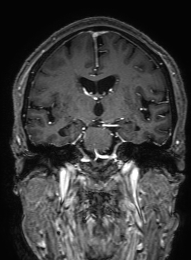 Cavernous hemangioma of the cerebellar falx (Radiopaedia 73025-83724 Coronal T1 C+ 189).jpg
