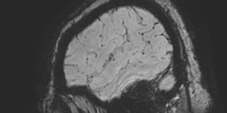 Cavernous hemangioma of the cerebellar falx (Radiopaedia 73025-83724 Sagittal BOLD 26).jpg
