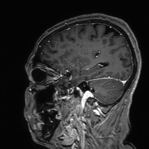 Cavernous hemangioma of the cerebellar falx (Radiopaedia 73025-83724 Sagittal T1 C+ 62).jpg
