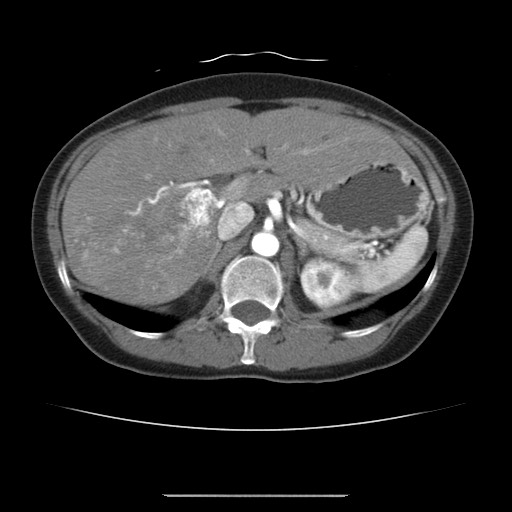 Cavernous hepatic hemangioma (Radiopaedia 75441-86667 A 34).jpg