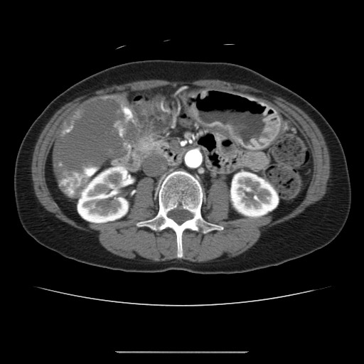 Cavernous hepatic hemangioma (Radiopaedia 75441-86667 A 54).jpg