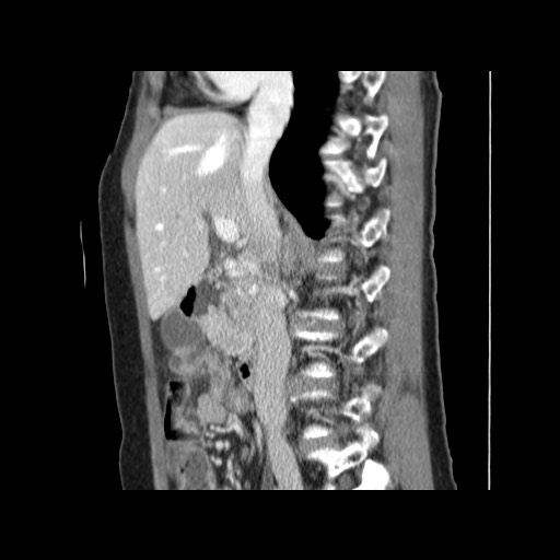 Cavernous hepatic hemangioma (Radiopaedia 75441-86667 D 83).jpg