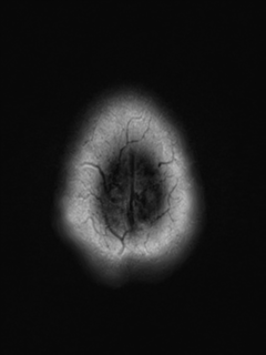 File:Cavernous malformation (cavernous angioma or cavernoma) (Radiopaedia 36675-38237 Axial T2 FLAIR 22).png