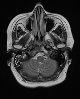 File:Cavernous sinus meningioma (Radiopaedia 63682-72367 Axial T2 4).jpg