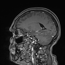 Cavernous sinus meningioma (Radiopaedia 63682-72367 Sagittal T1 C+ 110).jpg