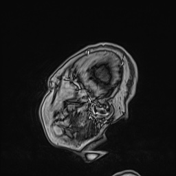 Cavernous sinus meningioma (Radiopaedia 63682-72367 Sagittal T1 C+ 24).jpg