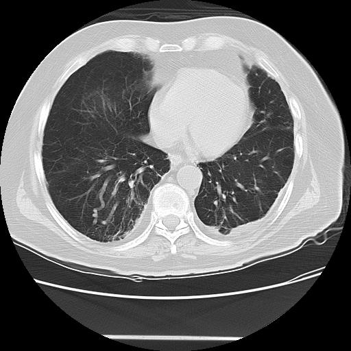 Cavitating pulmonary metastases (Radiopaedia 89545-106544 Axial lung window 39).jpg