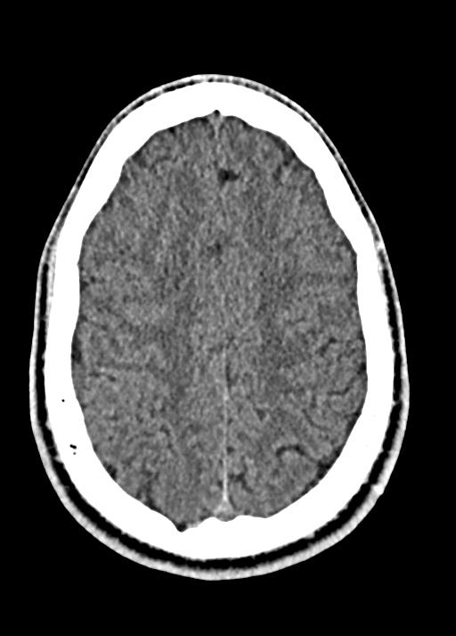 Cavum septum pellucidum and cavum vergae (Radiopaedia 77797-90060 Axial Brain Window 79).jpg