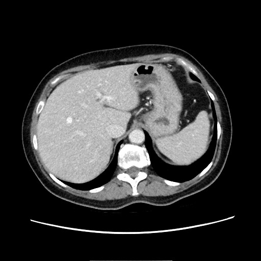 Cecal adenocarcinoma (Radiopaedia 75909-87331 A 23).jpg