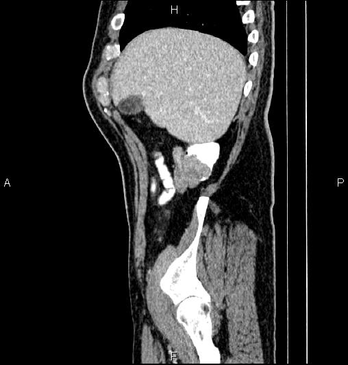 Cecal adenocarcinoma (Radiopaedia 85324-100916 E 14).jpg