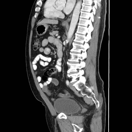 Cecal mass causing appendicitis (Radiopaedia 59207-66531 C 37).jpg