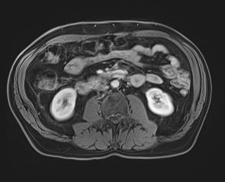 Cecal mass causing appendicitis (Radiopaedia 59207-66532 T1 C+ PV phase 70).jpg