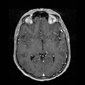 File:Central-variant posterior reversible encephalopathy syndrome (PRES) (Radiopaedia 43880-47358 Axial T1 C+ 75).jpg