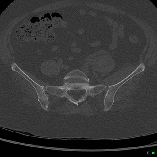 File:Central fracture-dislocation of the acetabulum (Radiopaedia 36578-38150 Axial bone window 7).jpg