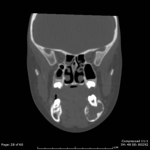 File:Central giant cell granuloma (Radiopaedia 45612-49754 Coronal bone window 28).jpg