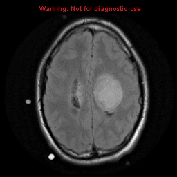 File:Central neurocytoma (Radiopaedia 13188-13206 Axial FLAIR 7).jpg