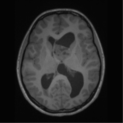 File:Central neurocytoma (Radiopaedia 37664-39557 Axial T1 39).png