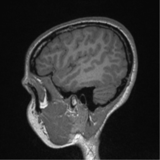 Central neurocytoma (Radiopaedia 37664-39557 Sagittal T1 20).png