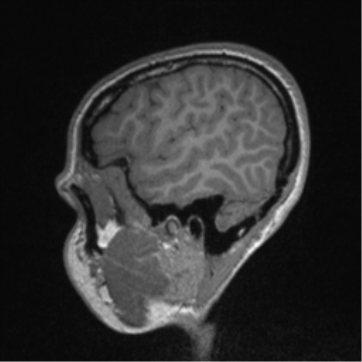 Central neurocytoma (Radiopaedia 37664-39557 Sagittal T1 79).png