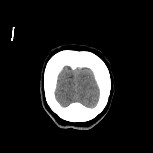 Central neurocytoma (Radiopaedia 65317-74346 Coronal non-contrast 58).png