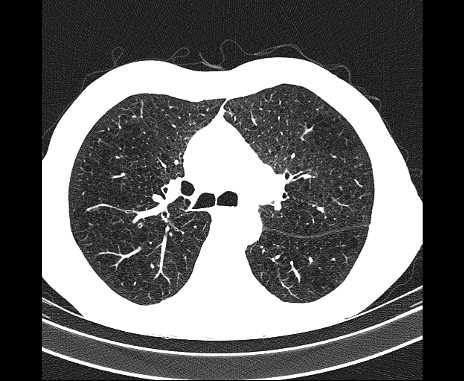 Centrilobular pulmonary emphysema (Radiopaedia 62468-70718 Axial lung window 29).jpg