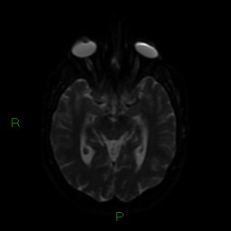 Cerebellar abscess (Radiopaedia 78135-90678 Axial DWI 44).jpg