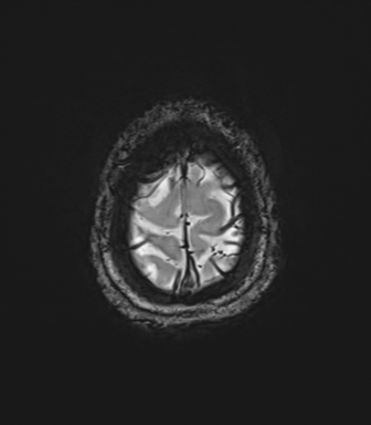 Cerebellar agenesis with hypoplastic pons (pontocerebellar hypoplasia) (Radiopaedia 57224-64138 Axial SWI 85).png