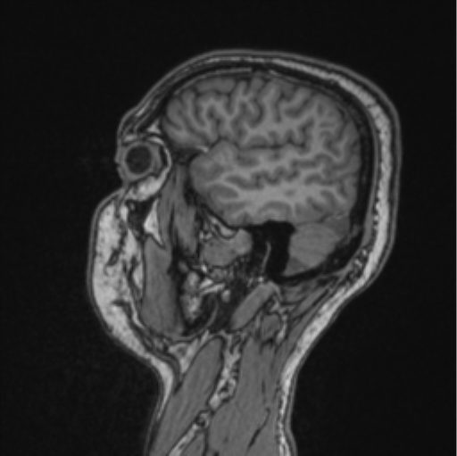 Cerebellar hemangioblastomas and pituitary adenoma (Radiopaedia 85490-101176 Sagittal T1 75).png