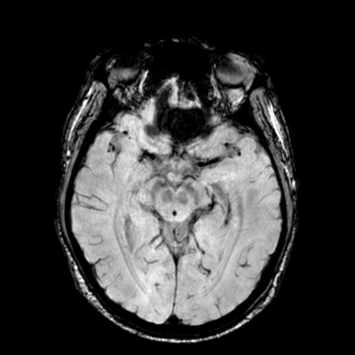 Cerebellar hemorrhage (Radiopaedia 37000-38666 Axial Gradient Echo 37).png