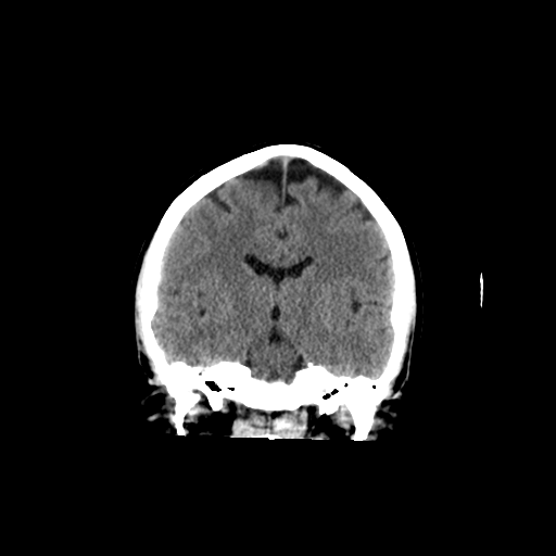 File:Cerebellar infarct due to vertebral artery dissection with posterior fossa decompression (Radiopaedia 82779-97030 Axial non-contrast 1).png