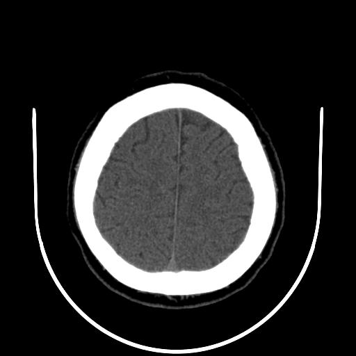 File:Cerebellar infarction (Radiopaedia 16625-16327 Axial non-contrast 31).jpg