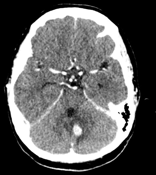 Cerebellar metastases - colorectal adenocarcinoma (Radiopaedia 40947-43652 Axial C+ 18).png