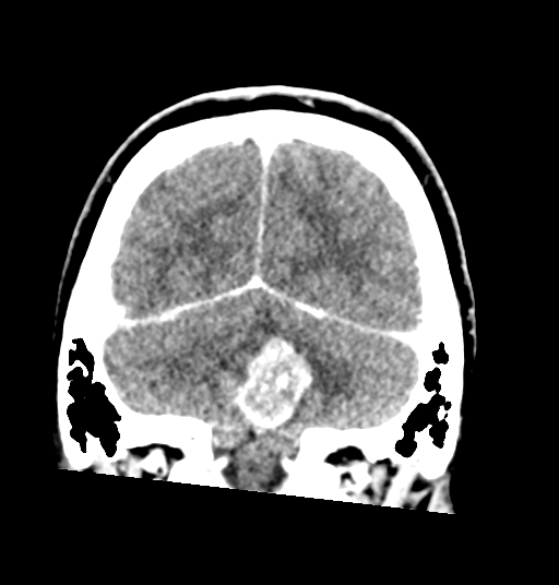 Cerebellar metastases - colorectal adenocarcinoma (Radiopaedia 40947-43652 Coronal C+ 73).png