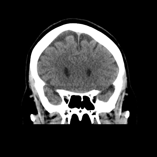 Cerebellar metastasis (cystic appearance) (Radiopaedia 41395-44258 Coronal non-contrast 22).png