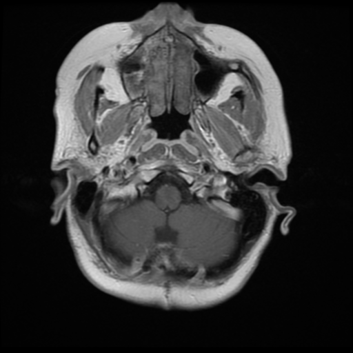 File:Cerebellar metastasis (cystic appearance) (Radiopaedia 41395-44268 Axial T1 C+ 3).png